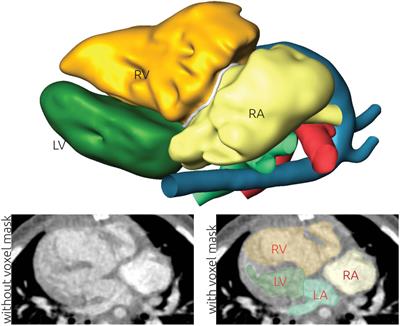 3D modeling and printing for complex biventricular repair of double outlet right ventricle